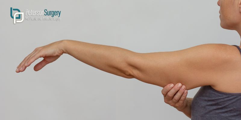 Understanding the Arm Lift Surgery Process: What to Expect